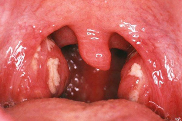 Viêm amidan là gì? Nguyên nhân, triệu chứng và cách chữa hiệu quả