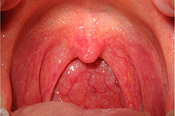 Phân biệt viêm họng do vi khuẩn và viêm họng do virus