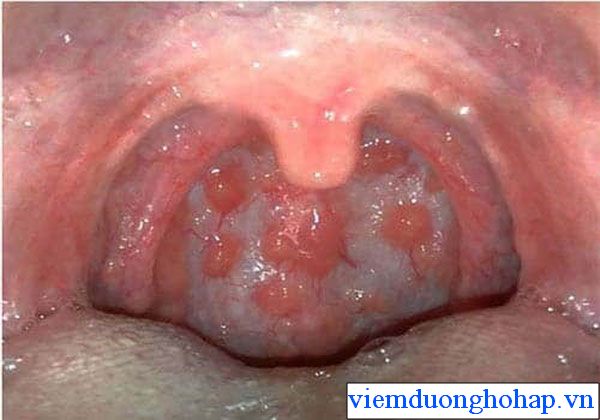 Thế nào là viêm họng hạt? 1