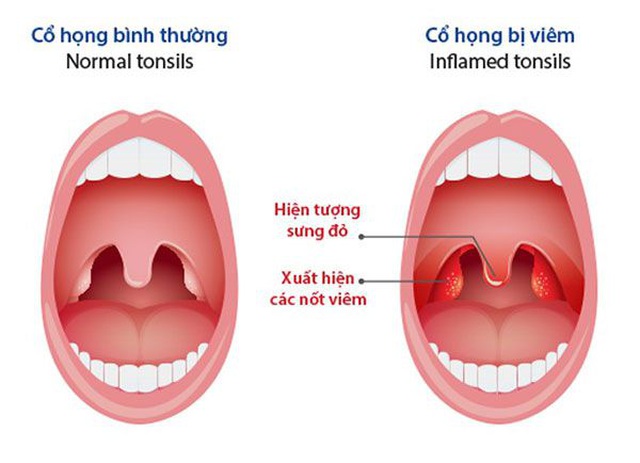 Đau rát họng, đờm nhiều, ho như cuốc kêu biết mẹo này mừng hơn bắt được vàng! 2