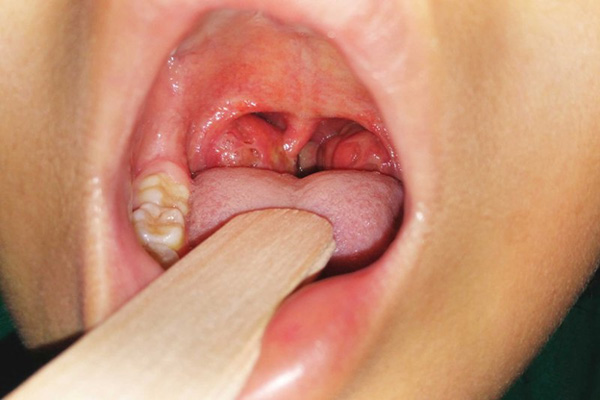 Tìm hiểu cách điều trị viêm amidan hốc mủ hiệu quả