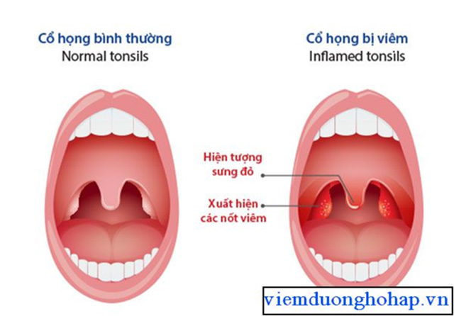 Suýt bỏ mạng chỉ vì viêm họng mạn tính 1