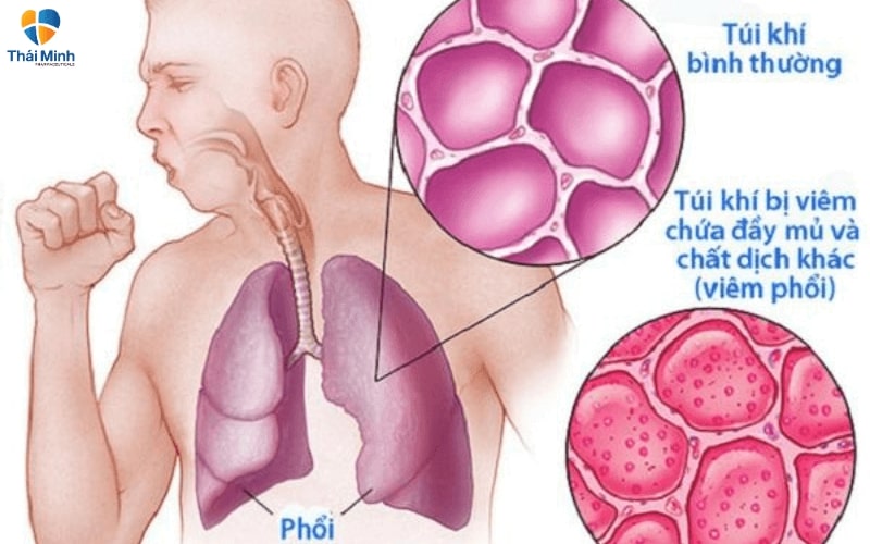 ho có đờm xanh dấu hiệu viêm phổi