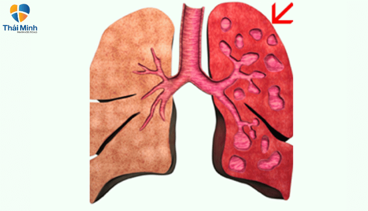  ho ra đờm có ít máu có thể do giãn phế quản