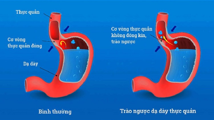 trào ngược dạ dày gây khô cổ họng về đêm