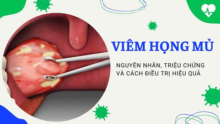 Viêm họng mủ có tự khỏi không? 3 cách điều trị tại nhà bạn có thể tham khảo