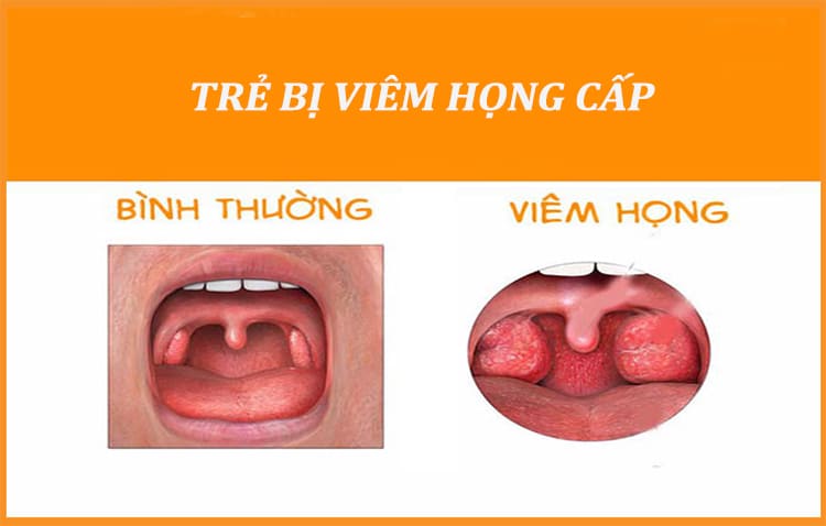 benh-viem-hong-cap-o-tre-em.jpg