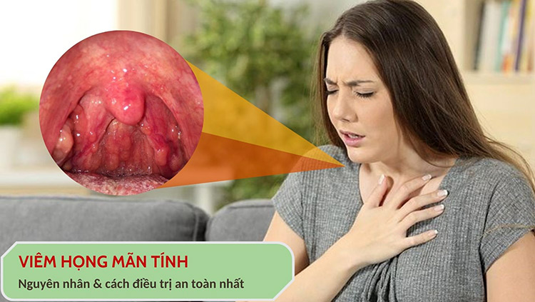 Viêm họng mãn tính là gì? 5 biến chứng cảnh báo mức độ nguy hiểm của bệnh